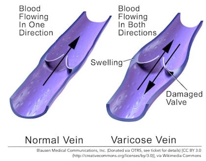Varicose Vein Diagram