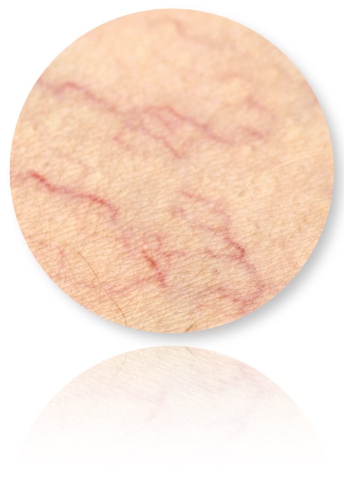 Spider Veins